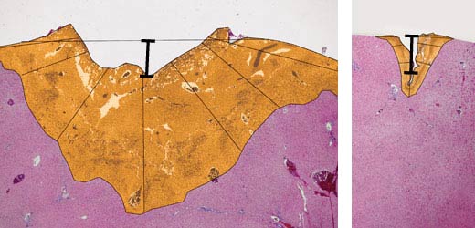 Comparative incisions